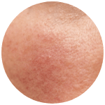 Rosacea